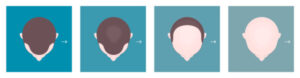 Eine Grafik zu erblich bedingten Haarausfall behandeln bei Männern.